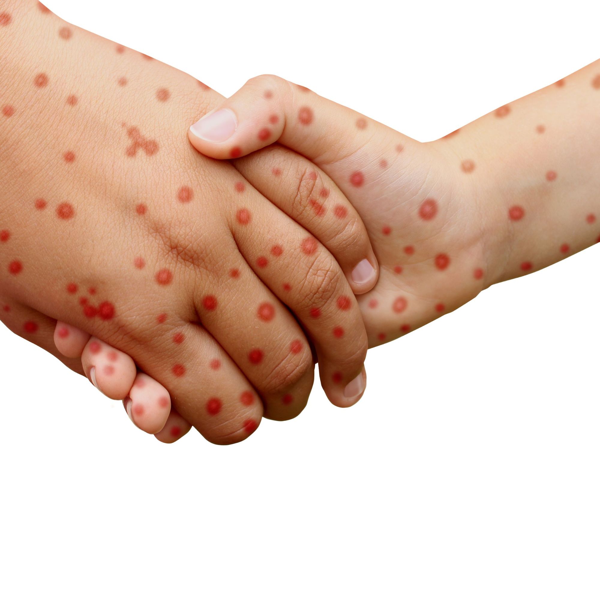 Recrudescence de la rougeole en France et en Europe, restons mobilisés