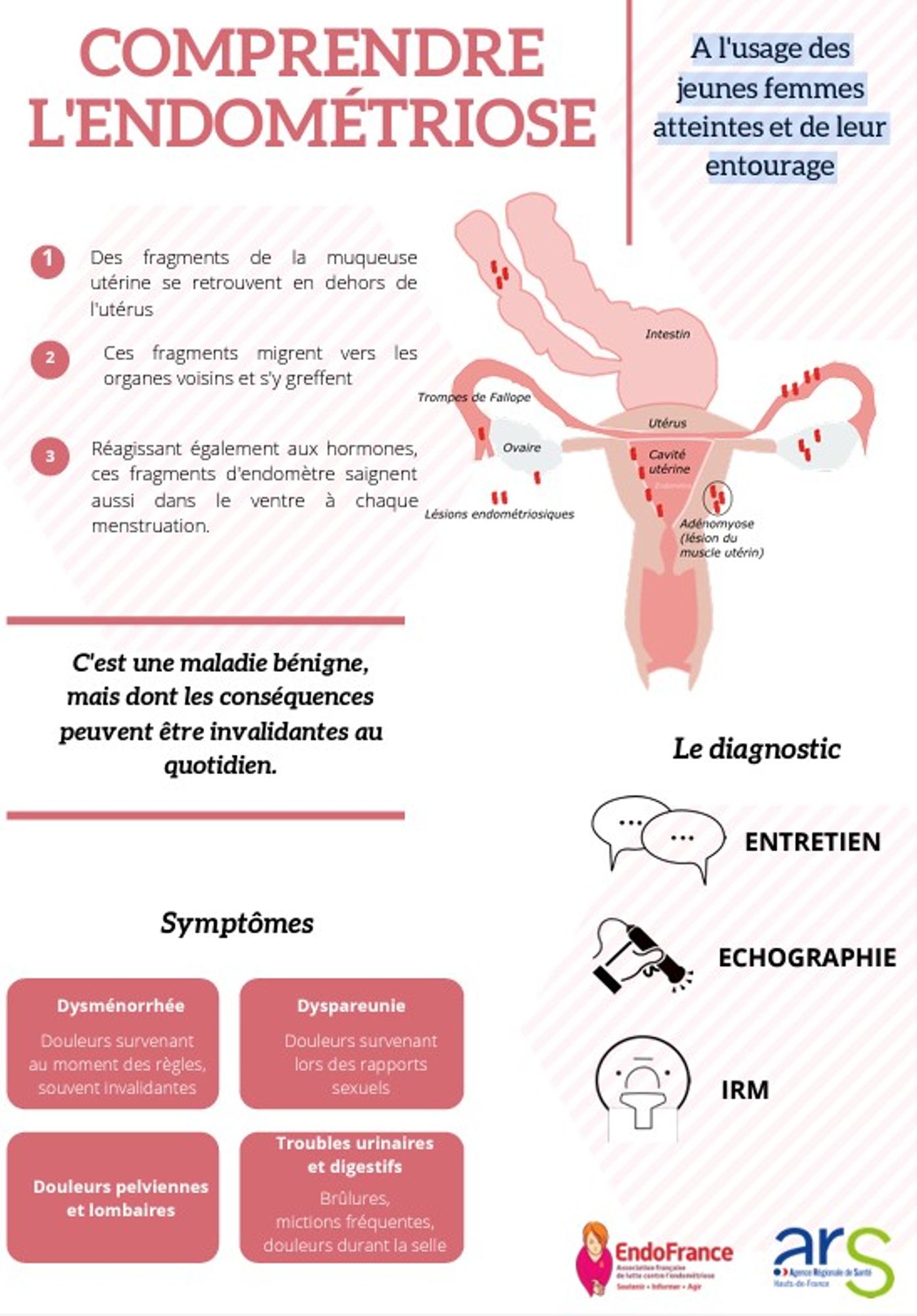 Comprendre l'endométriose