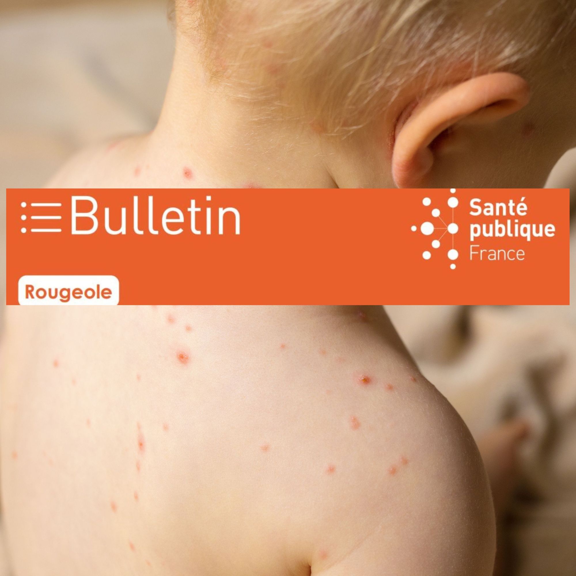 Rougeole en France 1er janvier au 31 décembre 2025